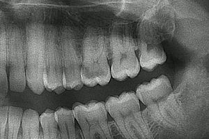 Initial radiograph of tooth 26. A large decay lesion can be seen.