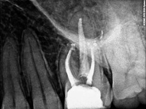 Final periapical radiograph of the endodontic treatment on tooth 26.