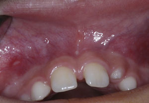 Frontal intraoral appearance demonstrating the absence of maxillary lateral incisors and loss of depth of vestibular sulcus in the region of left maxillary lateral incisor.