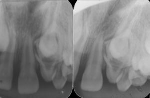 Periapical radiograph and Clark's technique.