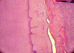 Dentin on the left, basophilic line: cementum, on the right, cementoid material (tumor). Darker material: fibrovascular connective tissue (H/E 200×).