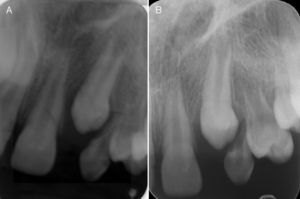 (A) Periapical radiography at 4 months postoperative. (B) Periapical radiography at 6 months postoperative.