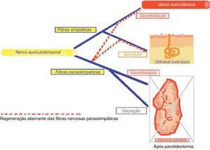 Regeneração aberrante das fibras nervosas após parotidectomia.
