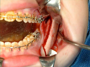 Osteotomia sagital bilateral da mandíbula.