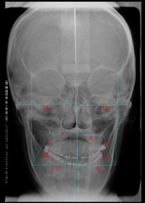Teleradiografia frontal pré-cirúrgica.