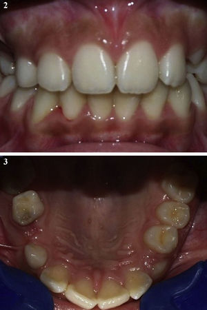 Pre-treatment intra-oral photographs showing the absence of definitive teeth in the maxilla right side.