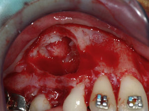 The surgical site after removal of odontoma.