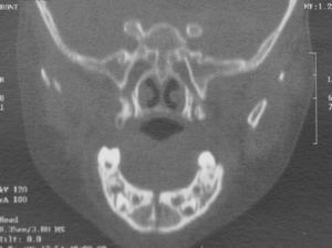 Preoperative CT – scout coronal.