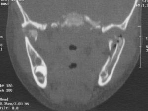 Preoperative CT – scout axial.