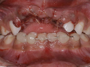 The immediate action was the suture of the lower lip and containment of the lower teeth wired Aciflex 1 and composite resin from right canine to the left.