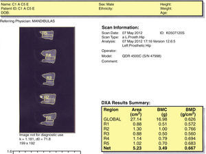 Exemplo de relatório DEXA scan.