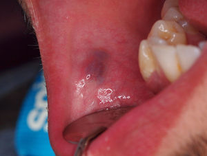 Clinical presentation of a blue colored papule on the anterior right buccal mucosa compatible with a vascular malformation.