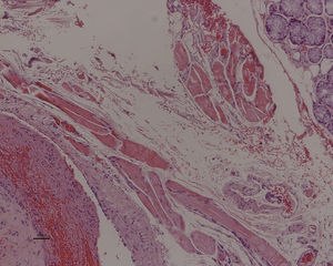 Histological image (100×) where it is possible to observe a venous malformation at the left lower corner. There is the presence of minor salivary glands of oral mucosa in the upper and right corner.