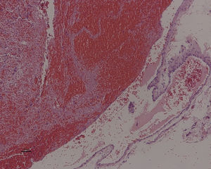 Histological image (100×) showing the dilated venous vessel with signs of thrombosis and with a thin wall vessel in the right lower corner.