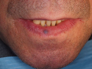 Clinical presentation of a blue colored papule on the lower lip compatible with a venous lake.