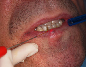Clinical aspect in the beginning of the photocoagulation procedure with a diode laser (975nm).