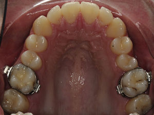 Arcada dentária superior com bandas ortodônticas nos primeiros molares superiores.