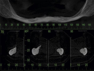 Tomografia computadorizada mostrando intensa atrofia mandibular.