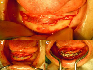(A) Mandíbula exposta observando-se severa reabsorção óssea. (B) Inserção dos Implantes tipo Cone Morse (Neodent®) na região entre os forames mentonianos. (C) Implantes (Neodent®) e placa de titânio (W. Lorenz) 2,4mm.