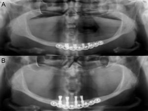 (A) Radiografia panorâmica do pós-operatório imediato. (B) Radiografia panorâmica após 5 meses observando-se osteointegração dos implantes.