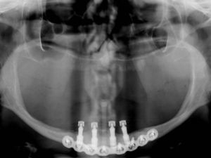 Radiografia panorâmica de controle após 2 anos de função mastigatória.