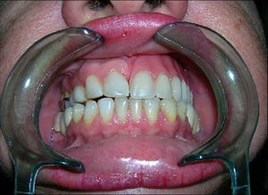 Confecção de prótese provisória removível.