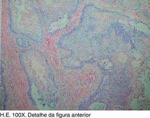 Laudo do exame histopatológico da peça operatória.