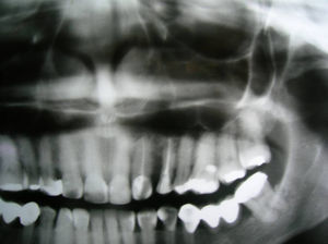 Exame radiográfico panorâmico dos maxilares exibia áreas radiolúcidas multiloculares.