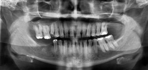 Radiografia panorâmica - Inicial.