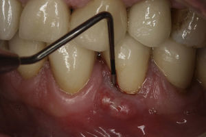 Figure showing probing periodontal pocket on the buccal aspect of the tooth 34. Note the presence of swelling and fistula.