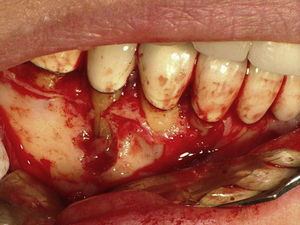 Vertical root fracture diagnosed during an exploratory surgery.