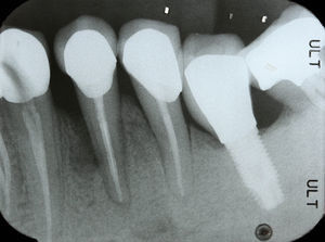 Periapical radiograph showing vertical bone loss on the mesial region of the tooth 34.