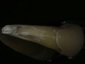 Photograph of tooth 34 showing the vertical root fracture line on the buccal surface of the root.