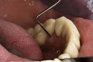 Probing of periodontal pocket in the lingual region teeth 44.