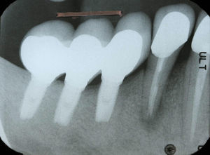 Periapical radiograph showing radiolucent area around the tooth root 44.