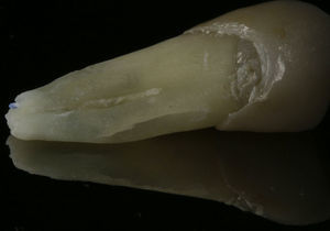 Photograph of tooth 44 showing the vertical root fracture on the lingual surface of the root.