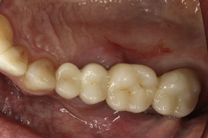 Clinical photograph showing inflammation of the palatal mucosa around fixed prosthesis.