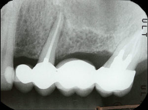 Periapical radiograph showing a radiolucent area around the tooth root 25.