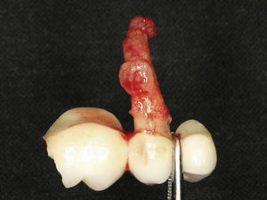 Photograph showing the prosthesis removed and granulation tissue around the root of the extracted tooth.