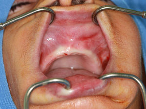 Intraoral aspect showing tumescence of the left labiogingival sulcus.