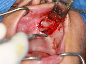 Dissection of the capsule and excision of the cyst.