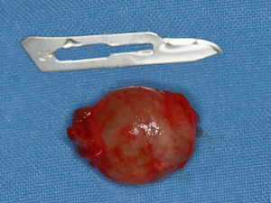 Gross aspect of the lesion (∼20mm), which was submitted for histopathological examination.