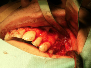 Photographs of surgical removal of fibroma – buccal mucoperiosteal flap.