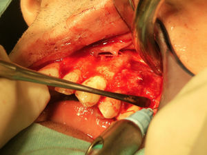Photographs of surgical removal of fibroma – lesion exposed.