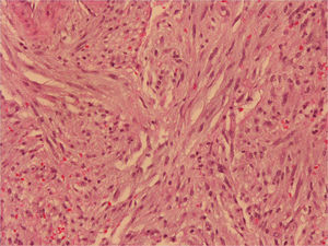 Histologic feature of biopsy specimen (hematoxylin–eosin stain).