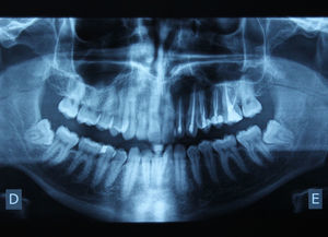 Control panoramic radiograph 18 months after removal of the lesion.