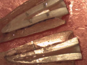 Imagem fotográfica de 2 amostras cujos sulcos se localizam ao mesmo nível (terço apical). Em ambas, a irrigação foi feita com seringa convencional. É visível uma maior remoção na amostra de baixo.