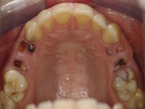 Intra oral exam (presence of root fragments on the right and left sides of the maxilla).