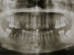 Panoramic radiograph (suggesting communication between the root tips and maxillary sinus).