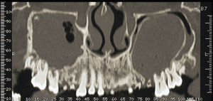 CT coronal slice (presence of teeth with apical periodontitis, of a mucosal thickening, fluid and opacification).